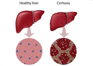 How to Keep Liver Healthy