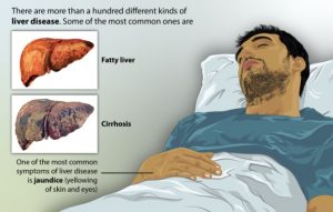 Types of Liver Disease